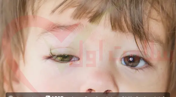 عکس عفونت ویروسی چشم