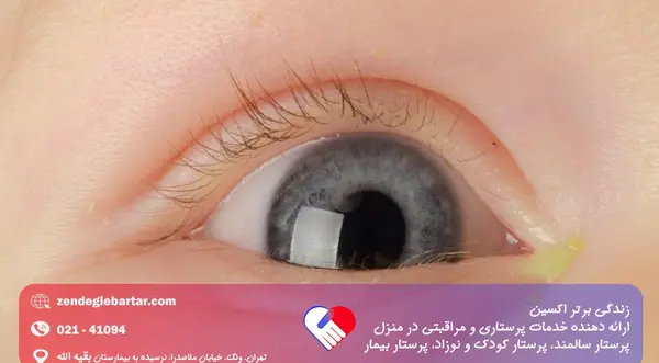 عکس عفونت ویروسی چشم