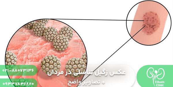 عکس ویروس اچ پی وی در مردان