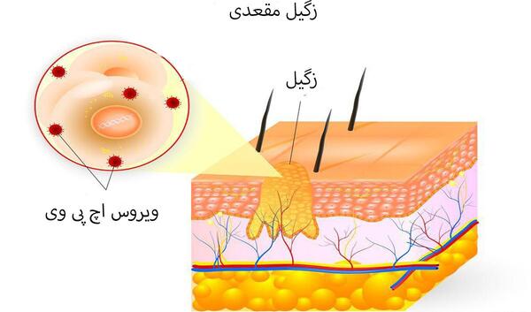 عکس ویروس اچ پی وی در زنان