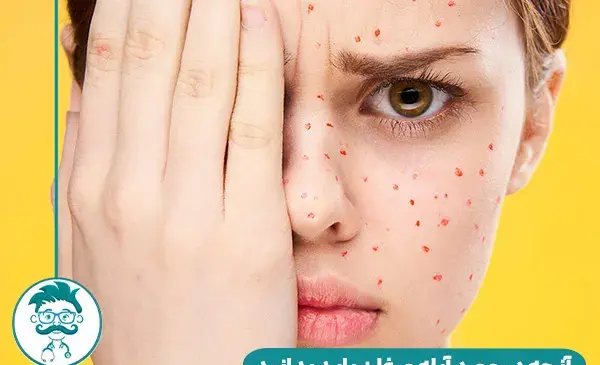 عکس ویروس آبله مرغان