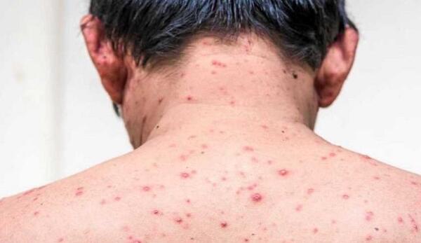 عکس ویروس آبله مرغان