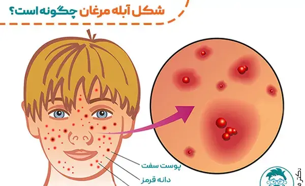 عکس ویروس آبله مرغان