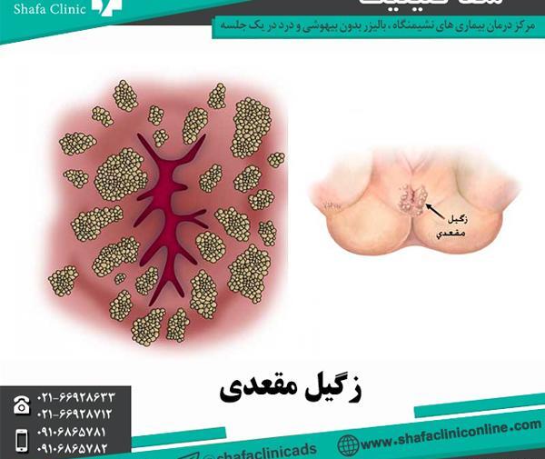 عکس های ویروس hpv