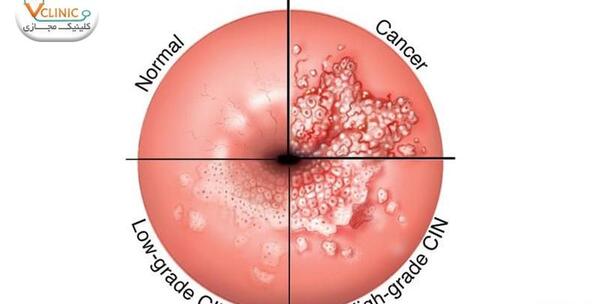 عکس های ویروس hpv