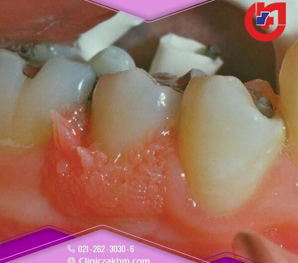 عکس ویروس hpv در دهان