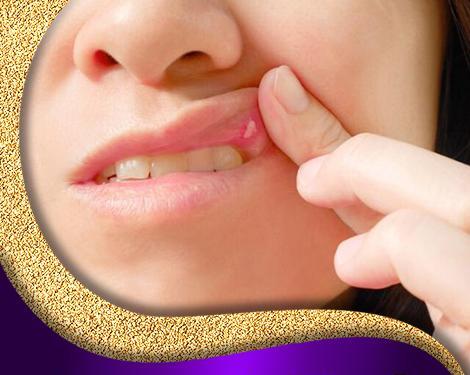 عکس ویروس hpv در دهان
