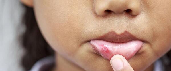 عکس ویروس hpv در دهان
