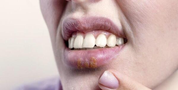 عکس ویروس hpv در دهان