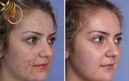 میکرونیدلینگ عکس قبل و بعد پاکسازی صورت