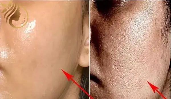میکرونیدلینگ عکس قبل و بعد پاکسازی صورت
