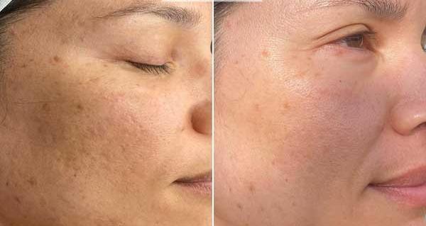 میکرونیدلینگ عکس قبل و بعد پاکسازی صورت