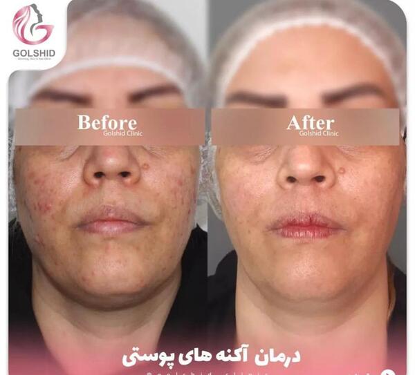 میکرونیدلینگ عکس قبل و بعد پاکسازی صورت