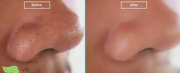 میکرونیدلینگ عکس قبل و بعد پاکسازی صورت