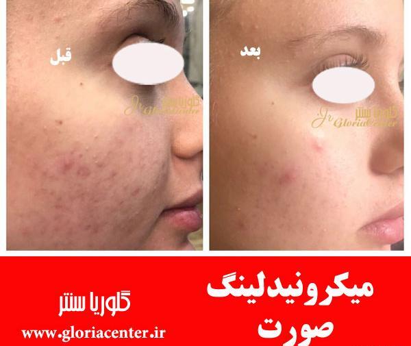 میکرونیدلینگ عکس قبل و بعد پاکسازی صورت