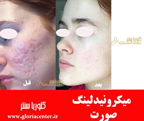 میکرونیدلینگ عکس قبل و بعد پاکسازی صورت