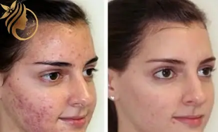 میکرونیدلینگ عکس قبل و بعد پاکسازی صورت
