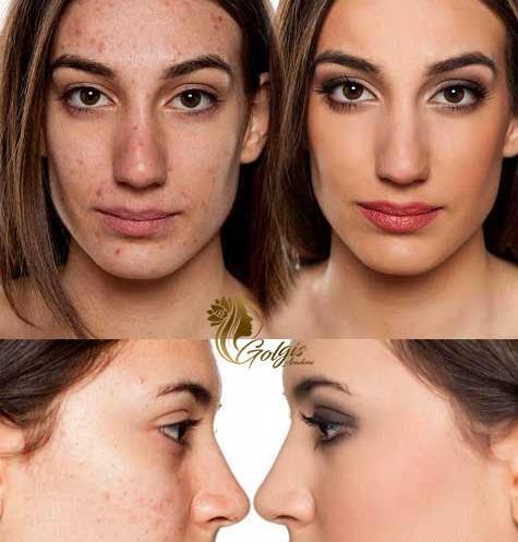 میکرونیدلینگ عکس قبل و بعد پاکسازی صورت
