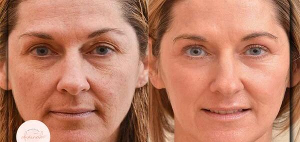 فيشيال چيست فیشیال عکس قبل و بعد پاکسازی صورت