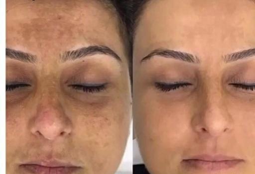 فيشيال چيست فیشیال عکس قبل و بعد پاکسازی صورت