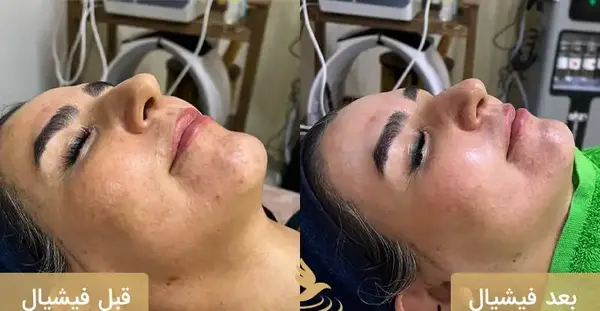 فيشيال چيست فیشیال عکس قبل و بعد پاکسازی صورت