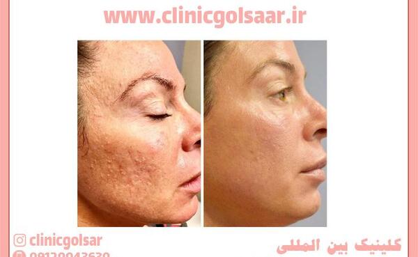 فيشيال چيست فیشیال عکس قبل و بعد پاکسازی صورت