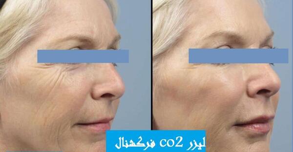 عکس قبل و بعد لیزر co2 فرکشنال