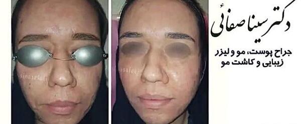 عکس قبل و بعد لیزر co2 فرکشنال