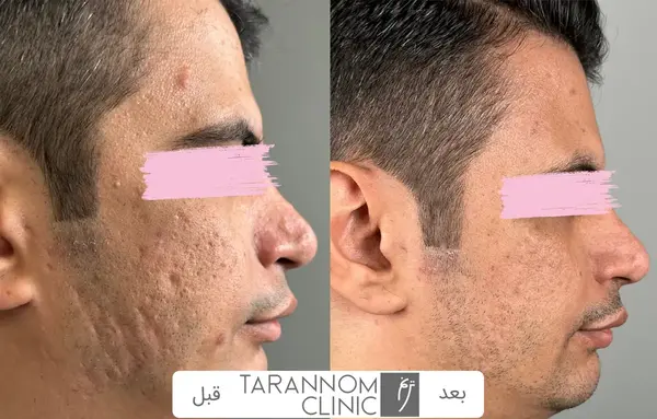 عکس قبل و بعد لیزر co2 فرکشنال