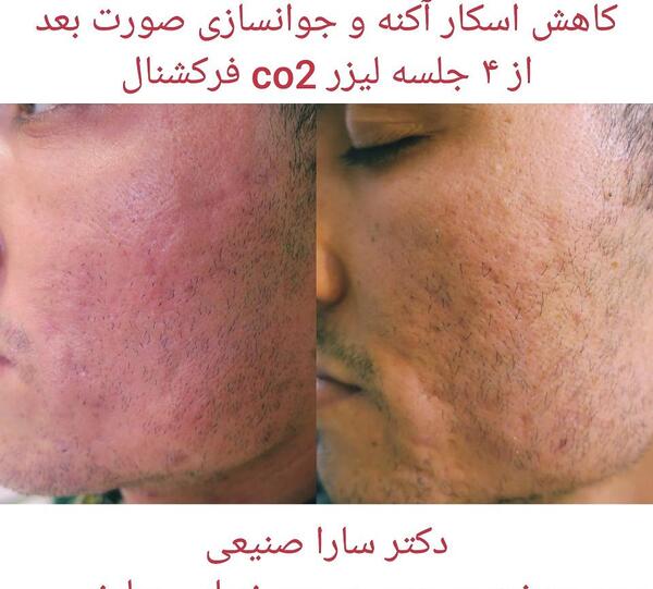 عکس قبل و بعد لیزر co2 فرکشنال