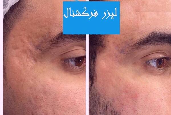 عکس قبل و بعد لیزر co2 فرکشنال