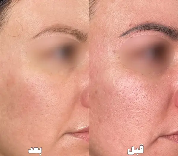 عکس قبل و بعد لیزر co2 فرکشنال