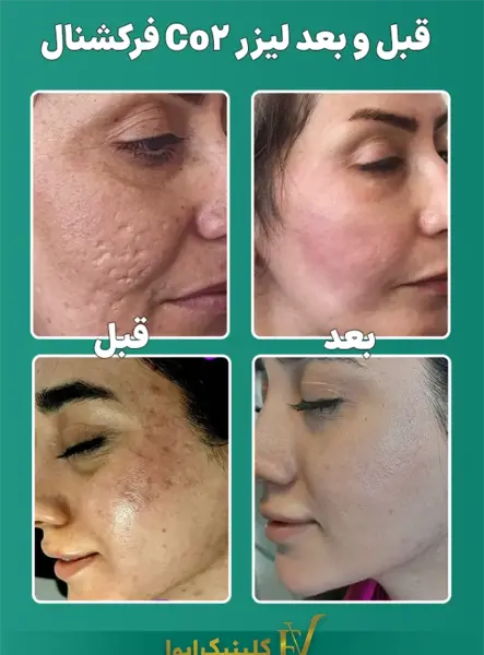 عکس قبل و بعد لیزر co2 فرکشنال
