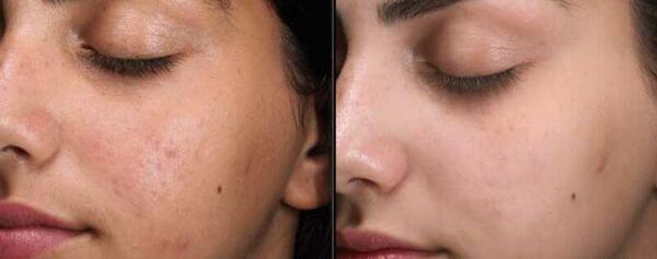 عکس های قبل و بعد پاکسازی صورت
