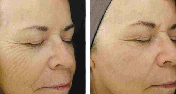 عکس های قبل و بعد پاکسازی صورت