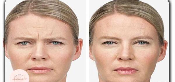 عکس های قبل و بعد پاکسازی صورت