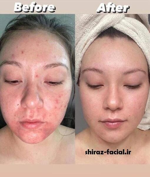 عکس های قبل و بعد پاکسازی صورت