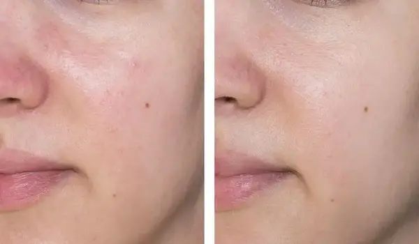 عکس های قبل و بعد پاکسازی صورت