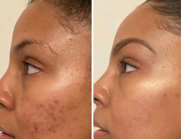 عکس های قبل و بعد پاکسازی صورت