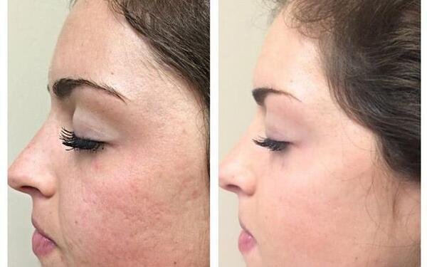 عکس های قبل و بعد پاکسازی صورت
