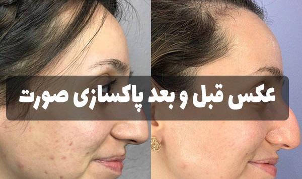 عکس های قبل و بعد پاکسازی صورت