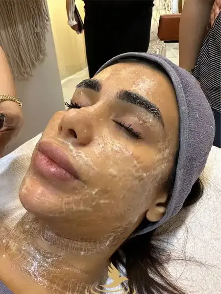 عکس های قبل و بعد پاکسازی صورت
