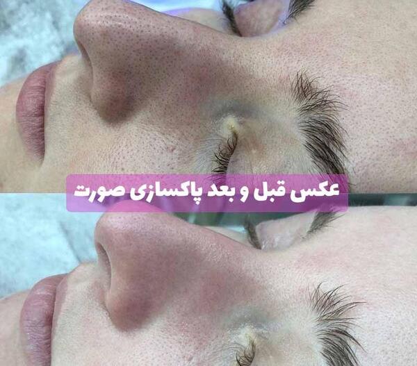 عکس های قبل و بعد پاکسازی صورت