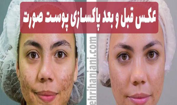 عکس های قبل و بعد پاکسازی صورت