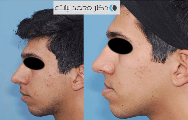 عکس قبل و بعد جراحی فک بالا
