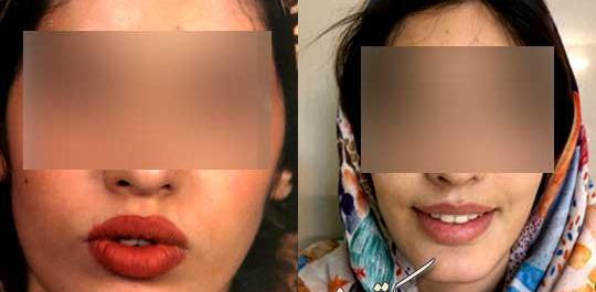 عکس قبل و بعد جراحی فک بالا