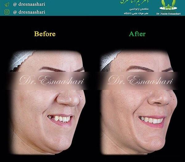 عکس قبل و بعد جراحی فک بالا