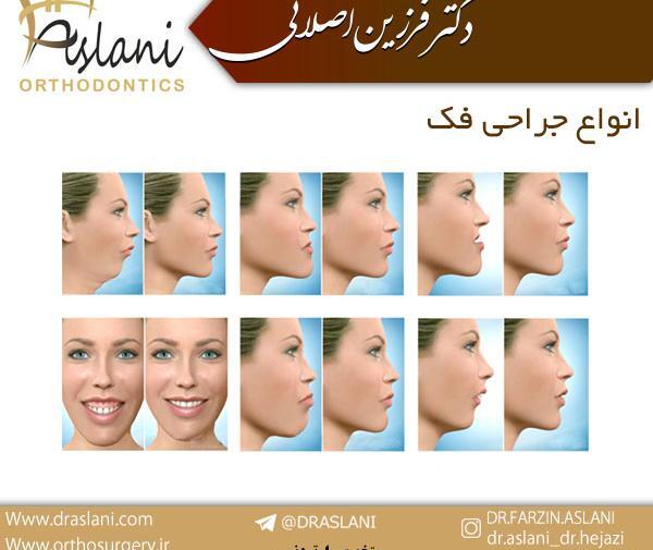 عکس قبل و بعد جراحی فک بالا