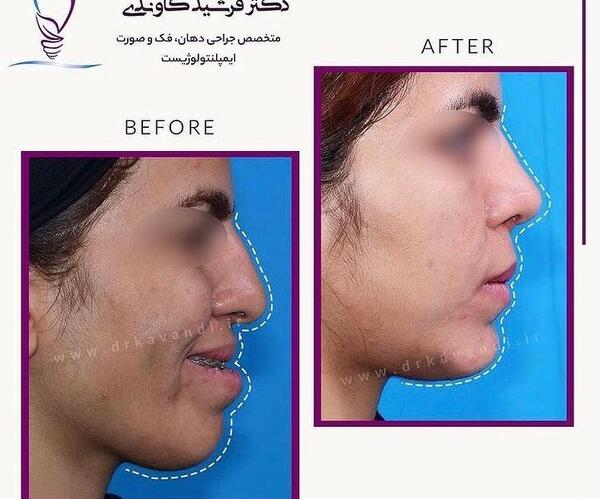 عکس قبل و بعد جراحی فک بالا