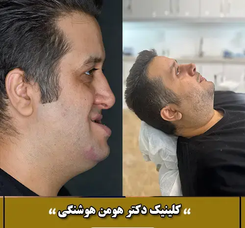 عکس قبل و بعد جراحی فک بالا